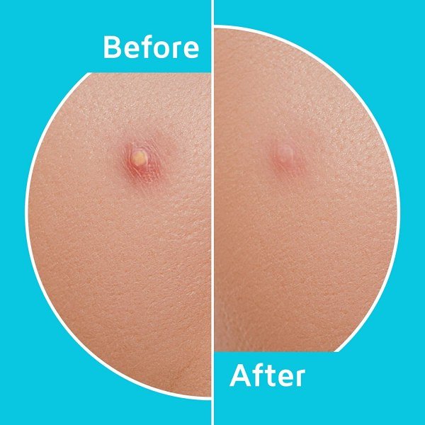 Acne Patches - Image 3